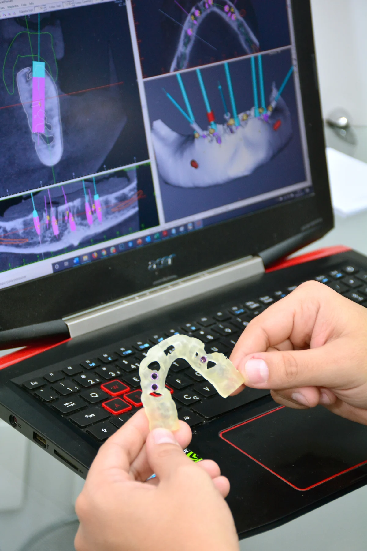 Planejamento digital de implantes na Hansen Odontologia